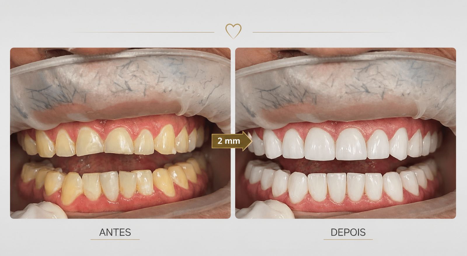 Antes e depois de 20 lentes em resina laboratorial