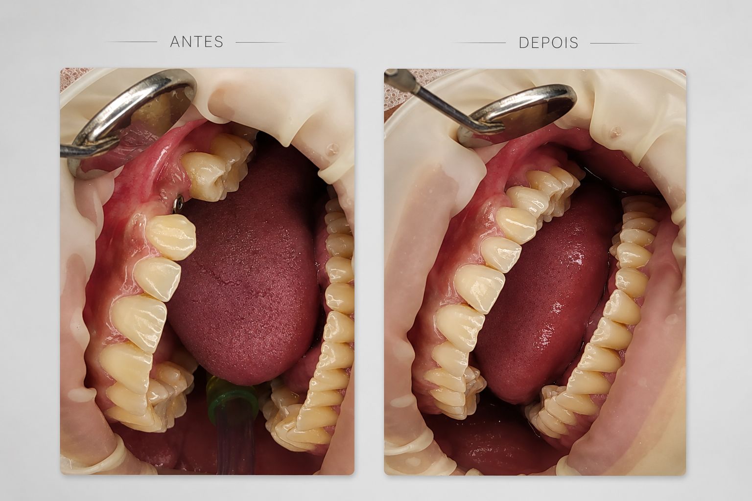 Antes e depois de coroa parafusada sobre implante