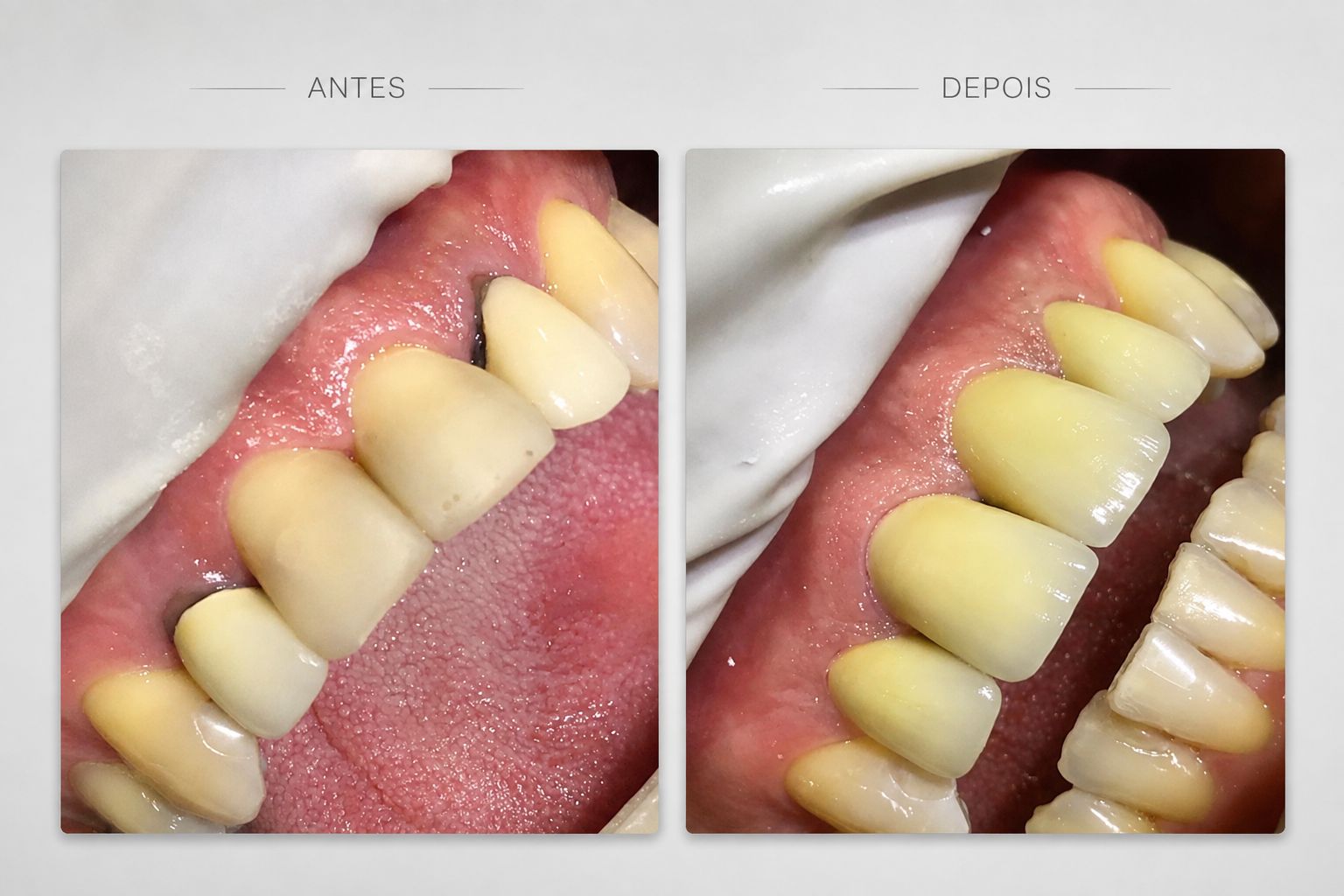 Antes e depois de coroas de porcelana