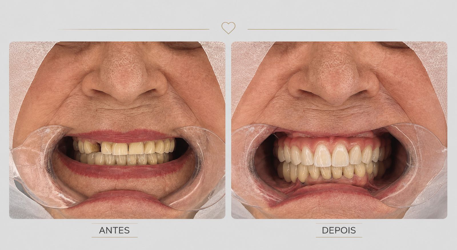 Antes e depois da troca de prótese protocolo superior