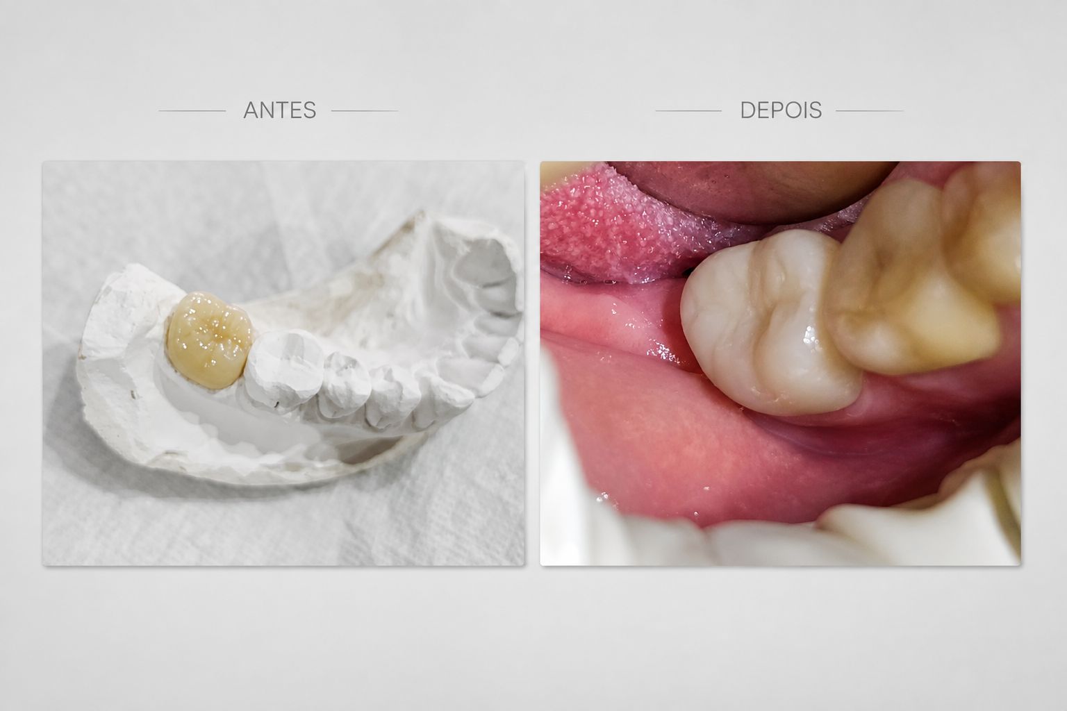 Antes e depois de bloco de cerômero em dente previamente tratado de canal