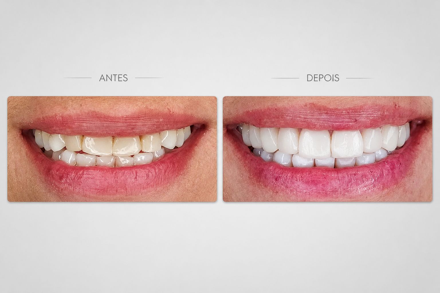 Antes e depois de rejuvenescimento dental
