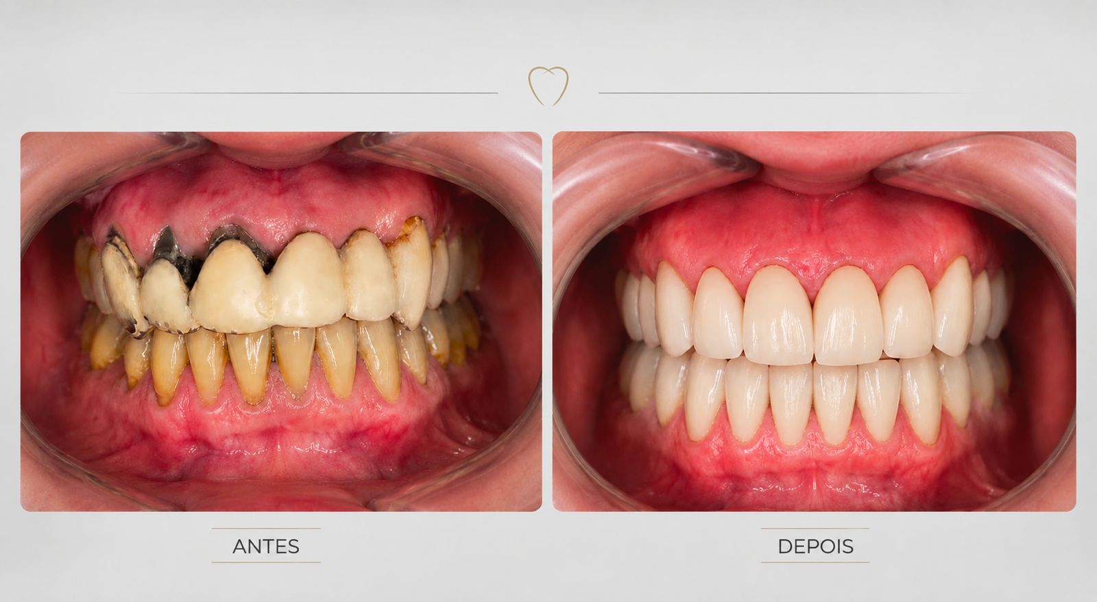 Antes e depois de 28 coroas em zircônia