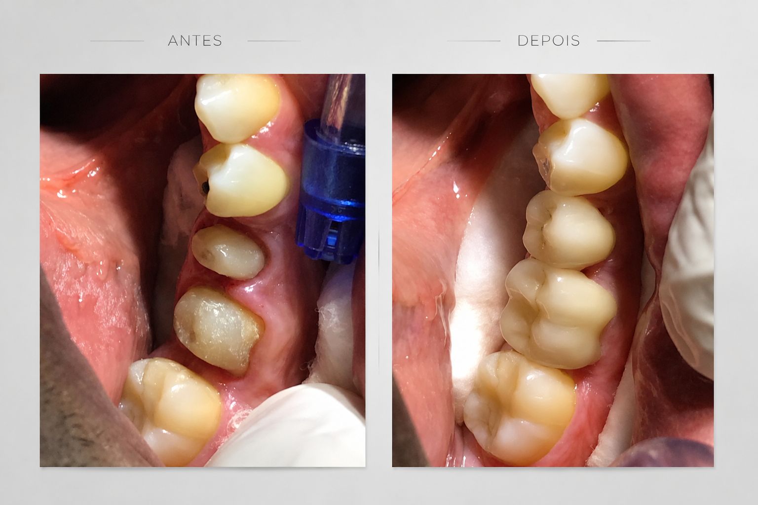 Antes e depois de coroas de porcelana em dentes posteriores