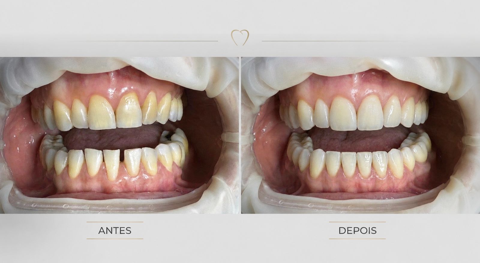 Antes e depois de lentes de porcelana