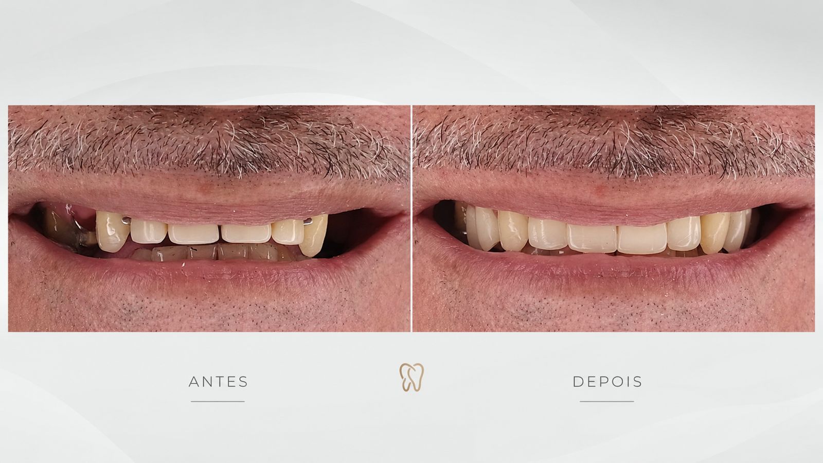 Antes e depois de prótese removível superior